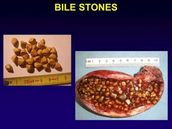 bile-stone